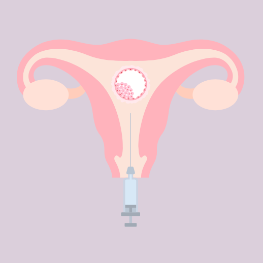 Grafik einer Gebärmutter, in die ein Embryo eingesetzt wird
