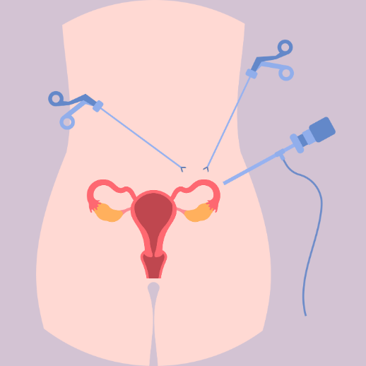 Grafik zeigt einen laparoskopischen Eingriff in die Gebärmutter der Frau