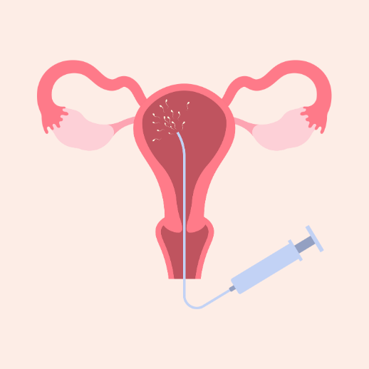 Grafik einer Gebärmutter, in die per Spritze Spermien eingeführt werden